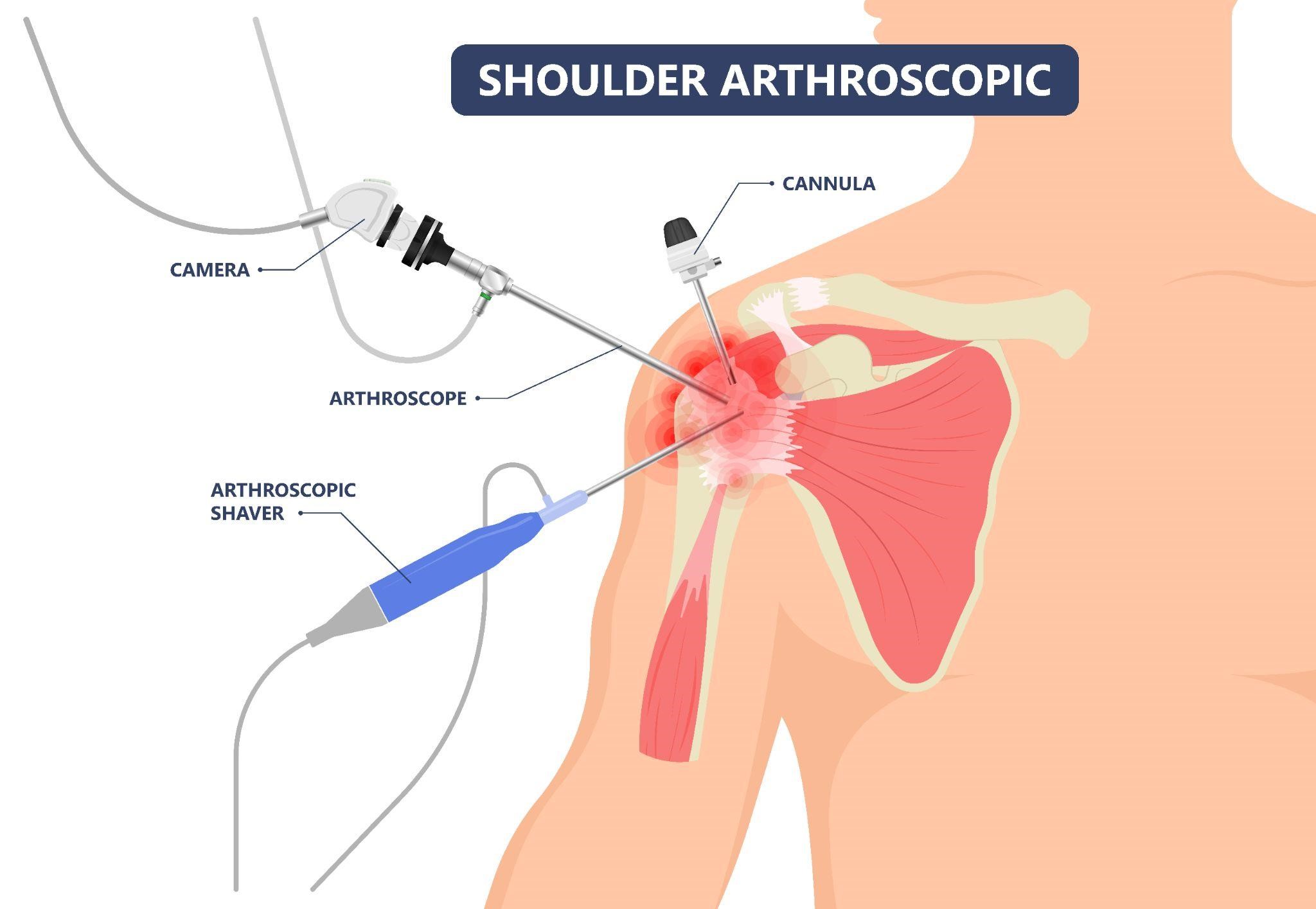 shoulder arthroscopy in West Delhi